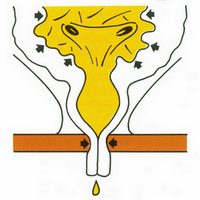 Représentation schématique de la partie basse du tractus urinaire chez la femme en cas d'incontinence réflexe
