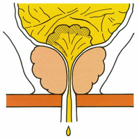 Schéma de la partie basse du tractus urinaire chez l'homme en cas d'incontinence par regorgement vésical